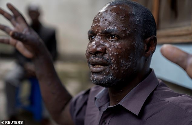 Santé/Afrique : l’épicentre du virus Mpox avec près de 4000 nouveaux cas par semaine